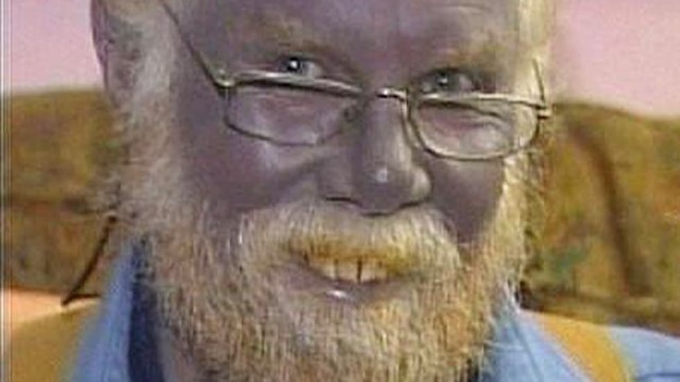 Man with completely blue skin dies at 62